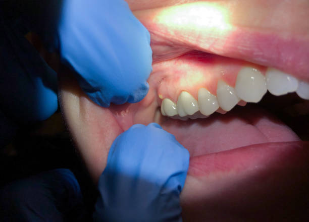 Emergency Dental Filling Replacement in WA